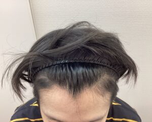 AGA治療5ヵ月後 26歳男性 生え際・頭頂部改善 新潟院