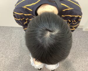 AGA治療5ヵ月後 26歳男性 生え際・頭頂部改善 新潟院