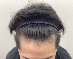 AGA治療11か月後｜33歳男性｜生え際改善・円形脱毛症改善｜新潟院