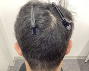 AGA治療11か月後｜33歳男性｜生え際改善・円形脱毛症改善｜新潟院