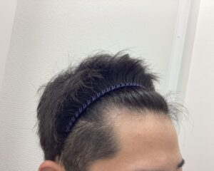 AGA治療11か月後｜33歳男性｜生え際改善・円形脱毛症改善｜新潟院
