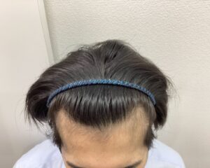AGA治療6ヵ月後　23歳男性　生え際・頭頂部改善　新潟院