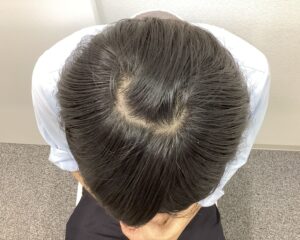 AGA治療6ヵ月後　23歳男性　生え際・頭頂部改善　新潟院