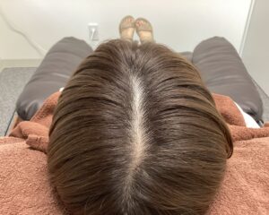 FAGA5ヵ月後　34歳女性　分け目改善　新潟院