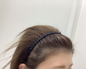 FAGA5ヵ月後　34歳女性　分け目改善　新潟院