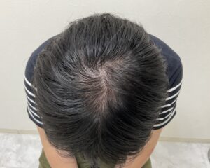 AGA治療前　31歳男性　生え際・頭頂部薄毛　岡山院