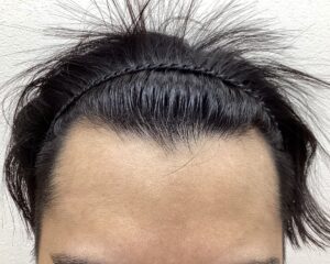 AGA治療6ヵ月目　28歳男性　生え際薄毛　横浜院