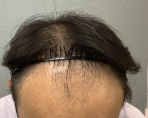 AGA治療前　53歳男性　生え際・頭頂部薄毛　金沢院