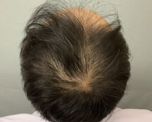 AGA治療前　53歳男性　生え際・頭頂部薄毛　金沢院