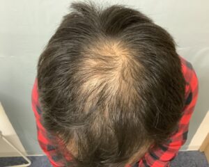 AGA治療前　38歳男性　生え際・頭頂部薄毛　金沢院