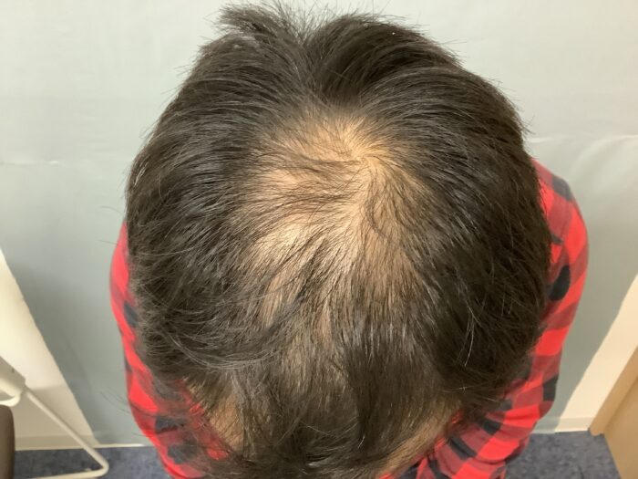 【38歳男性】生え際と頭頂部の薄毛がAGA治療で改善｜金沢院