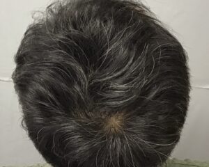 AGA治療8ヶ月後　53歳男性　生え際・頭頂部改善　金沢院