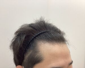 AGA・円形脱毛症治療前　33歳男性　生え際の薄毛　新潟院