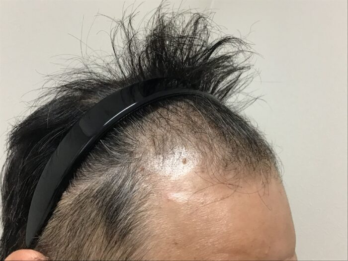 AGA治療初診　43歳男性　生え際薄毛　鹿児島院