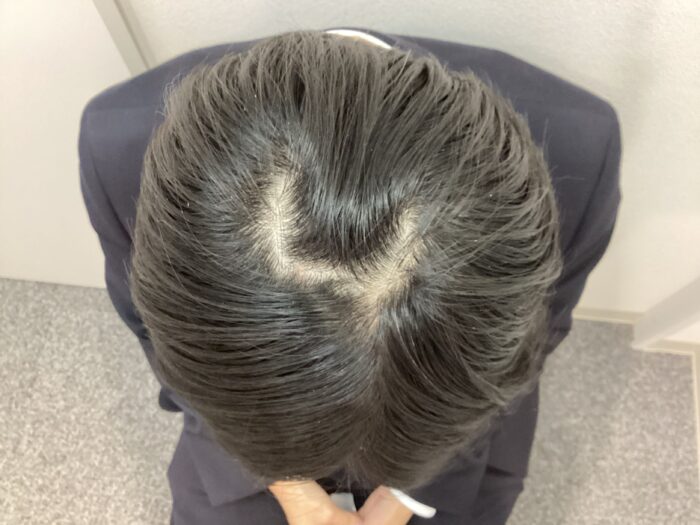 【23歳男性】生え際・頭頂部の薄毛がAGA治療で改善｜新潟院
