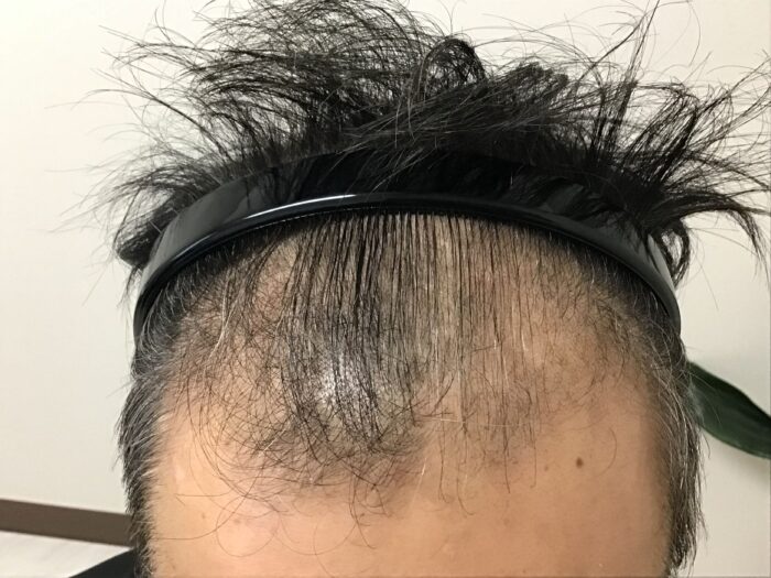 AGA治療初診　43歳男性　生え際・前頭部薄毛　鹿児島院