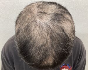 全頭型の円形脱毛症治療3ヵ月目　37歳女性　横浜院