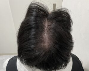 AGA治療前　21歳男性　生え際・頭頂部薄毛　岡山院