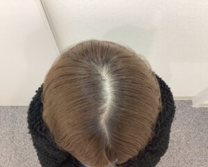 FAGA治療前　34歳女性　分け目薄毛　新潟院