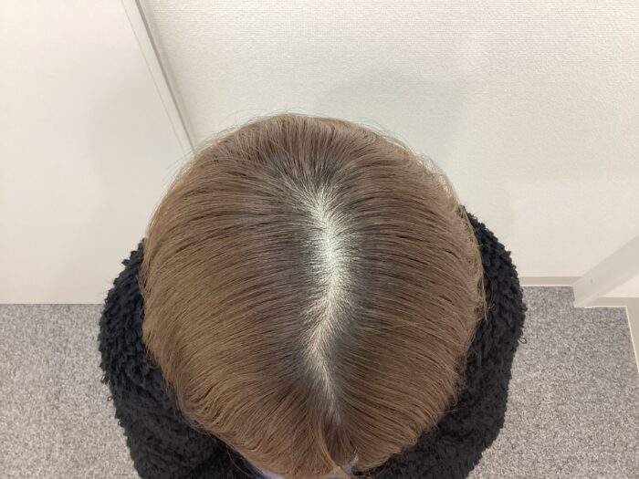 【34歳女性】分け目の薄毛がFAGA治療で改善｜新潟院