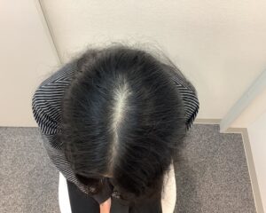 AGA治療前　29歳女性　生え際・頭頂部薄毛　新潟院