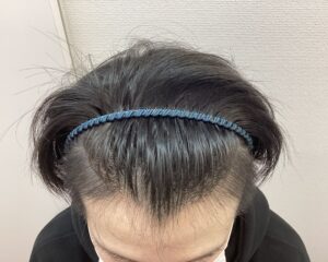 AGA治療前 26歳男性 生え際・頭頂部薄毛 新潟院