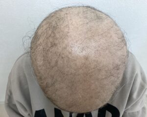 全頭型の円形脱毛症治療1ヵ月目　37歳女性　横浜院