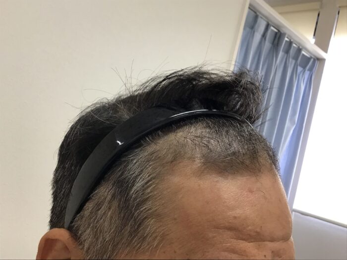 AGA治療3ヶ月後　43歳男性　生え際改善　鹿児島院　