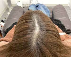 FAGA治療前　34歳女性　分け目薄毛　新潟院