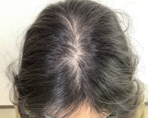 FAGA治療前　35歳女性　生え際・分け目薄毛　姫路院