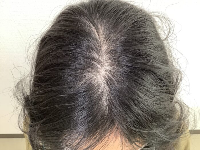 【35歳女性】分け目・生え際の薄毛がFAGA治療で改善｜姫路院