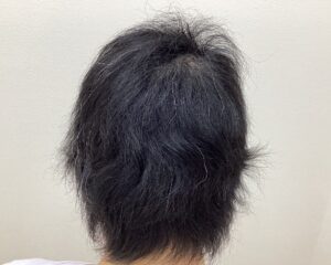 全頭型の円形脱毛症治療7ヵ月目　37歳女性　横浜院