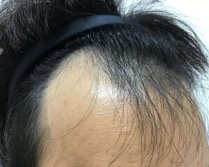 AGA治療前＿23歳男性＿生え際の薄毛＿大阪梅田院