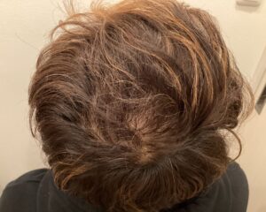AGA治療後_44歳男性_生え際・頭頂部改善_広島院