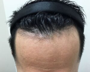AGA治療後_38歳男性_生え際・頭頂部の改善_大阪梅田院