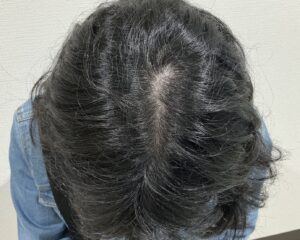 FAGA2年6ヵ月後　35歳女性　生え際・分け目改善　姫路院