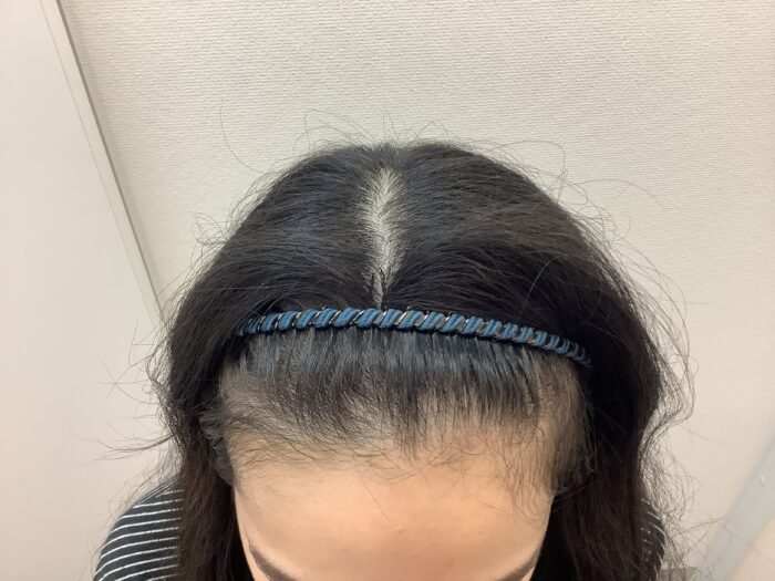 【29歳女性】生え際・分け目の薄毛がFAGA治療で改善｜新潟院