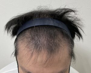 AGA治療3ヵ月後　38歳男性　生え際・頭頂部薄毛　岡山院