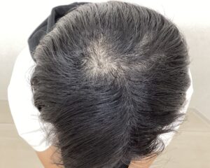 AGA治療3ヵ月目　28歳男性　頭頂部薄毛　横浜院