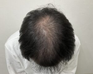 AGA治療3ヵ月後　38歳男性　生え際・頭頂部薄毛　岡山院