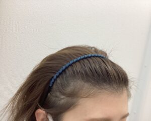 FAGA治療前　34歳女性　分け目薄毛　新潟院