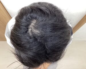 AGA治療6ヵ月目　28歳男性　頭頂部薄毛　横浜院