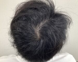 AGA治療4か月後 29歳男性 生え際改善 姫路院