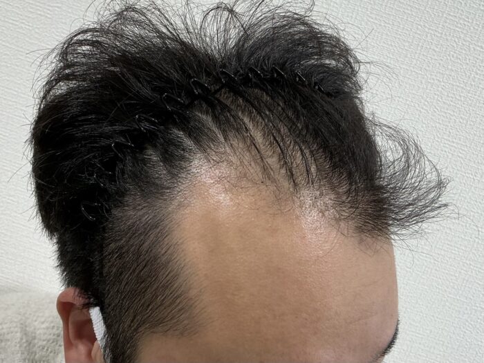【29歳男性】生え際・頭頂部の薄毛がAGA治療で改善｜姫路院