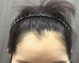 FAGA治療4ヶ月後　31歳女性　生え際・頭頂部改善　京都院
