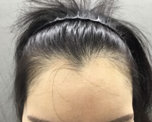FAGA治療前　31歳女性　生え際・頭頂部薄毛　京都院