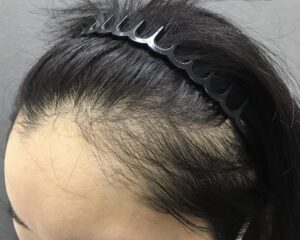 FAGA治療前　31歳女性　生え際・頭頂部薄毛　京都院