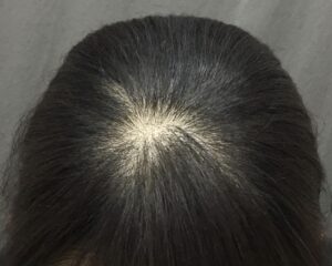 FAGA治療4ヶ月後　31歳女性　生え際・頭頂部改善　京都院