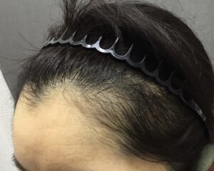 FAGA治療4ヶ月後　31歳女性　生え際・頭頂部改善　京都院