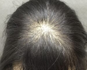 FAGA治療前　31歳女性　生え際・頭頂部薄毛　京都院